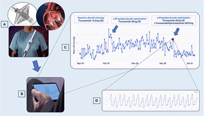 A 3-Year Single Center Experience With Left Atrial Pressure Remote Monitoring: The Long and Winding Road